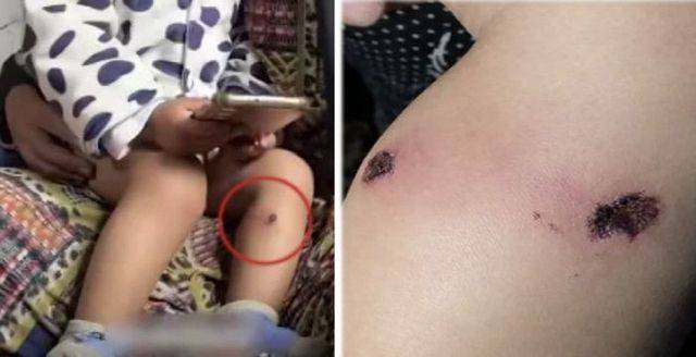 이스라엘군의 담뱃불 고문 흔적. 팔레스타인 TV, 알자지라 방송