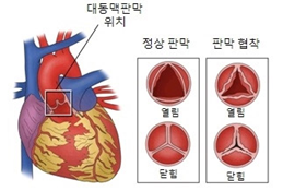 대동맥판막협착증이 생기면 심장에서 온몸으로 피를 내보내는 대동맥으로의 혈류에 문제가 생긴다. 서울아산병원 제공