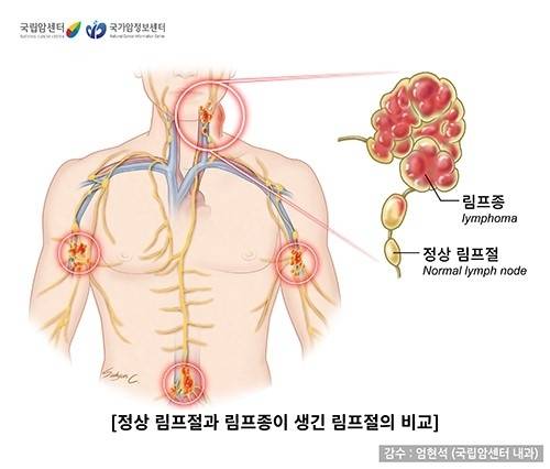 정상 림프절과 림프종이 생긴 림프절의 비교. 자료 : 국립암센터