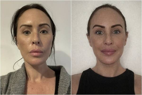 수천만원을 들여 대대적인 안면거상술을 받은 호주 여성이 “오히려 더 늙어 보인다”는 악성 댓글에 시달리고 있다는 사연이 전해졌다. 왼쪽이 수술 전 모습. 피플 캡처