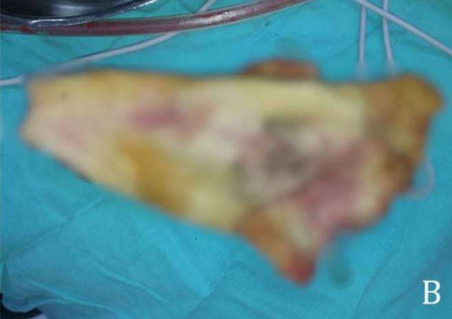 20대 여성의 뱃속에서 나온 수술용 거즈. 사진=임상증례보고(Clinical Case Reports)