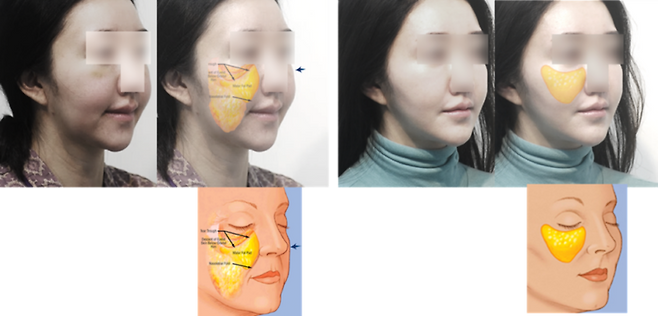 아래로 떨어진 광대뼈를 위로 올려주는 것만으로 근육과 볼살이 위로 올라가서 뺨 지방 덩이가 제 위치로 돌아간 모습입니다.