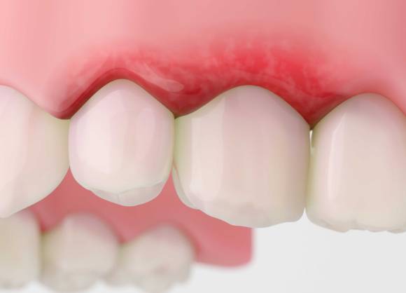 잇몸 건강을 해치는 생활 습관과 그 위험성이 전문의 설명을 통해 나왔다. 사진은 본 기사 내용과 무관. [사진=Oral-B]