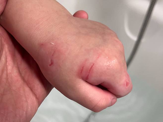 부산 한 국공립 어린이집에서 보육교사가 4살 원생에게 상처를 입힌 사건이 발생했다. /사진=온라인 커뮤니티 갈무리