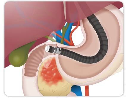 복부 초음파내시경으로 췌장을 살펴보는 모습. /자료=대한췌장담도학회