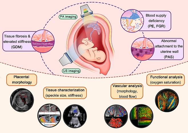 태반 이상에 기인한 주산기 질환과 영상 접근법에 대한 개요.[POSTECH 제공]