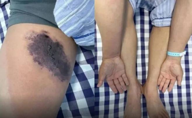 거미에 물린 뒤 허벅지, 팔 등에 멍이 생기고 괴사가 발생한 남성의 증상 사진. 사진=제트뉴스