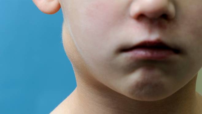 임파선염은 '과도한 피로가 누적되어 휴식이 필요하다'는 면역 체계의 명확한 신호이다｜출처: 클립아트코리아