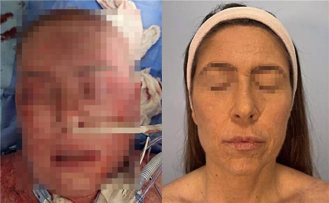 사진 좌측=치료 1개월 후 점차 얼굴 피부가 회복되는 모습 / 우측=치료 6개월 후 호전된 모습 (머리카락은 가발 추정). 사진=Journal of Surgical Case Reports