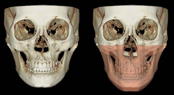 상악골이 길어지면 광대뼈 역시 하방으로 이동합니다.