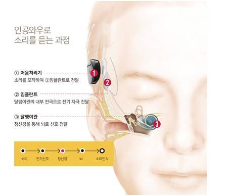[호주 청각전문기업 코클리어 제공]