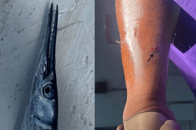 동갈치와 동갈치 부리에 찔린 흔적이 보이는 남성의 다리(오른쪽). 사진=큐레우스(Cureus)