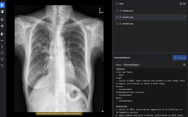 숨빗AI가 개발한 생성형 AI 의료기기 AIRead-CXR .(사진제공=숨빗AI)