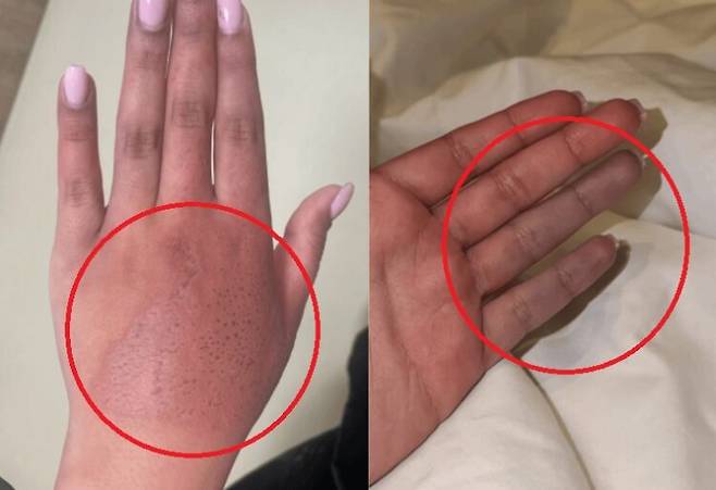 해파리에 쏘인 손에 나타난 증상. 사진=큐레우스(Cureus)