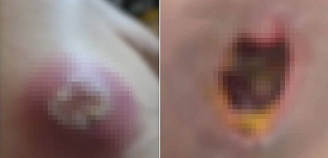 경기 한 프랜차이즈 마사지숍에서 손님 동의 없이 불법 의료 시술을 했다. 사진은 피부 괴사 증상을 겪은 피해 여성 A씨의 상처 부위. 사진 SBS ‘뉴스헌터스’ 캡처