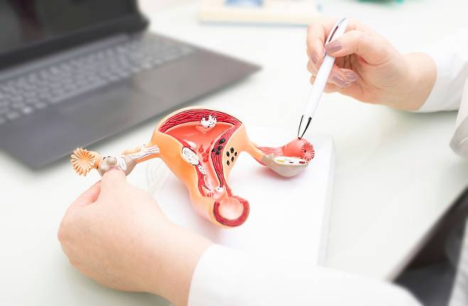 ‘다낭성 난소 증후군(PCOS, Polycystic Ovary Syndrome)’의 정식 명칭이 변경된다.​/사진= 클립아트코리아