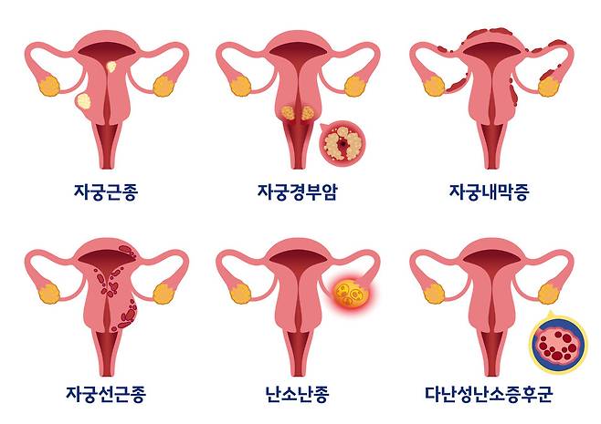 자궁내막증을 비롯한 주요 자궁질환 간 차이를 비교한 인포그래픽. 게티이미지뱅크