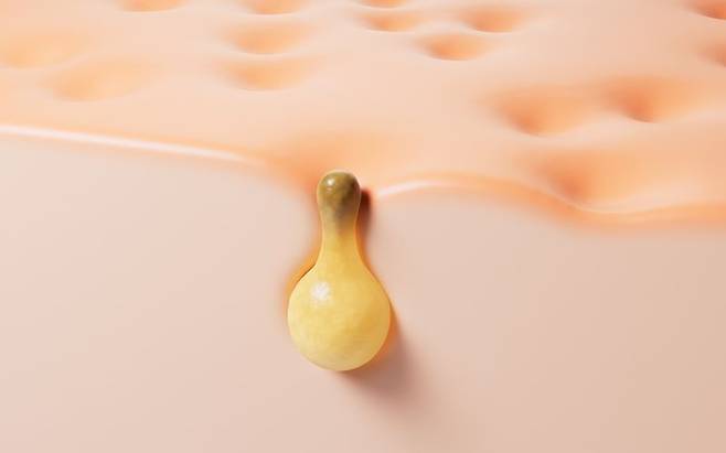 여름에는 피지선이 과열, 피지 분비량이 많아지며 모공이 늘어나고 넓어지기 쉽다. 사진: 셔터스톡