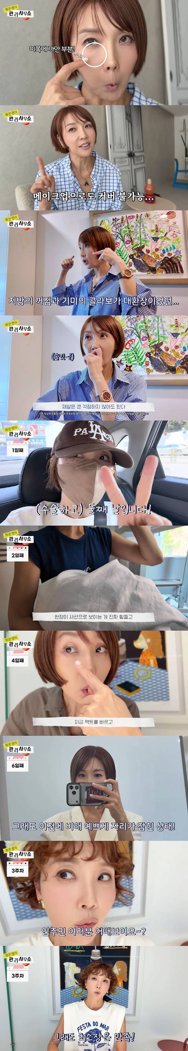 TV personality Choi Eun-kyung (53) revealed her transformed face following a lower eyelid fat repositioning procedure and expressed her satisfaction with the results.On the 5th, a video titled Real Review of Lower Eyelid Fat Repositioning! How Satisfied Am I? was posted on her YouTube channel, Choi Eun-kyungs Management Office.In the video, Choi Eun-kyung confessed, Even before, my under-eye area would get dark and sunken when I was tired. But it would go away if I ate well and rested, adding, When I was tired, I found it impossible to cover it up with makeup. She revealed the dark circles under her eyes and explained, After struggling for four months, the area under my eyes started to sink in, making the dark circles even more noticeable, which led her to decide to consult a plastic surgeon.After visiting the clinic for a consultation, Choi Eun-kyung shared her concerns: I really hate how my under-eye area sinks in when I smile. Because the area under my eyes is sunken, it looks dark, and combined with my age spots, its a real mess, she shared her concerns. In response, the attending specialist explained, Laser-assisted lower eyelid fat repositioning can neatly resolve this, and provided a detailed explanation of the procedure.After the consultation, Choi Eun-kyung reviewed before-and-after photos and ultimately decided to proceed with the surgery.On the first day after the procedure, Choi Eun-kyung revealed her slightly swollen face and explained, Because my eyes were numbed, I saw double and the ceiling looked slanted—it was really tough, adding, It returned to normal as time passed.The recovery process wasnt entirely smooth. On the sixth day after the procedure, Choi Eun-kyung visited a filming set and confessed, It still doesnt feel like my own eyes; its awkward. The swelling had spread down to my jaw, and it didnt look like my face. It was so awkward that I wondered why I even did it.However, as time passed, Choi Eun-kyung revealed a much more natural appearance about three weeks after the procedure and expressed her satisfaction. She said, The best part is that I definitely hear fewer comments about looking tired, adding, Since the dark hollows under my eyes are gone, my eyes look much clearer. She continued, Im also satisfied that I didnt get a single bruise, adding, It definitely looks better now.However, she emphasized that she does not unconditionally recommend plastic surgery. Choi Eun-kyung stated, This is merely a personal choice; Im not encouraging plastic surgery, and noted, Everyones situation is different.