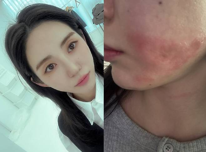 권민아가 공개한 흉터