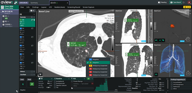 AVIEW LCS, Coreline Soft's AI-powered diagnostic support solution for predicting lung cancer malignancy. (Source=Coreline Soft)