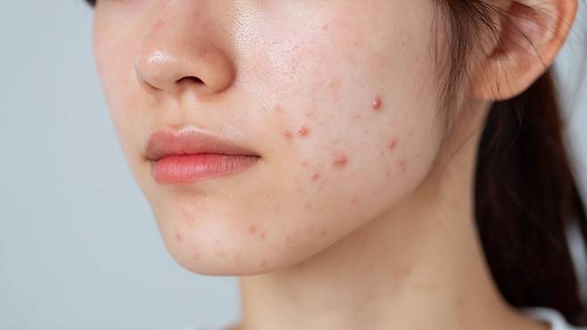 여드름 흉터는 복합적인 기전으로 발생하는 만큼, 상태에 맞는 관리 전략이 필요하다|출처: 클립아트코리아