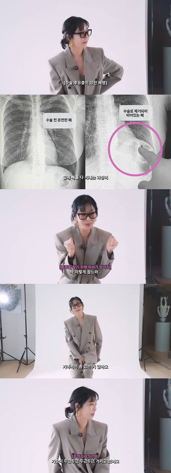 Actress and painter Lee Hye-Yeong shared the behind-the-scenes story of the physical pain she suffered following lung cancer surgery and her struggles with cancer battling disease through her YouTube channel. Lee confessed that the surgery, which involved cutting her ribs, was physically demanding, and that enduring the pain subsequently led to additional ailments, including herniated discs in her neck and lower back.Lee, who revealed that she was diagnosed with lung cancer on her 10th wedding anniversary, explained that she had a history of pneumothorax and decided to undergo surgery as the cancer cells grew. She recalled the difficult time she had to endure pain alone at home after the surgery, as it coincided with the COVID-19 pandemic.Lee also spoke about the hardships of cancer battling disease, mentioning her family history where both parents suffered from stomach cancer. She is currently preparing for her fifth-year follow-up examination and expressed positive anticipation for the results of her final test scheduled for August.