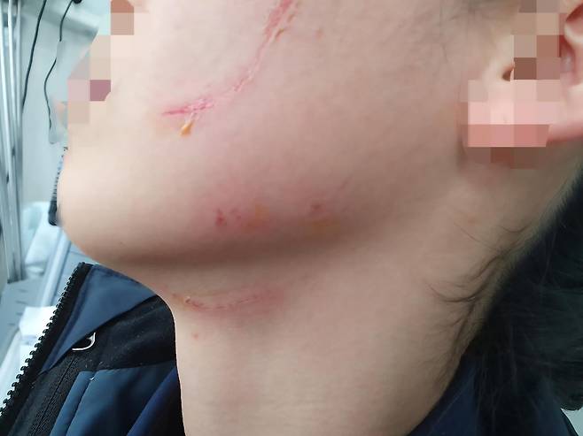 청주여자교도소에서 한 교도관이 수용자에게 폭행당해 얼굴에 상처가 난 모습. 법무부 제공