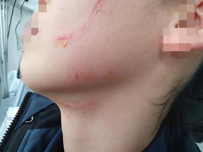 청주여자교도소 교도관이 수용자를 제지하다 얼굴에 입은 상처. 교정공무원에게는 경찰·소방처럼 별도의 위험근무수당이 지급되지 않는다. 법무부 제공