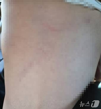 대구 달서구 장애 전담 어린이집  아동학대 피해 아동의 등 사진(독자 제공)