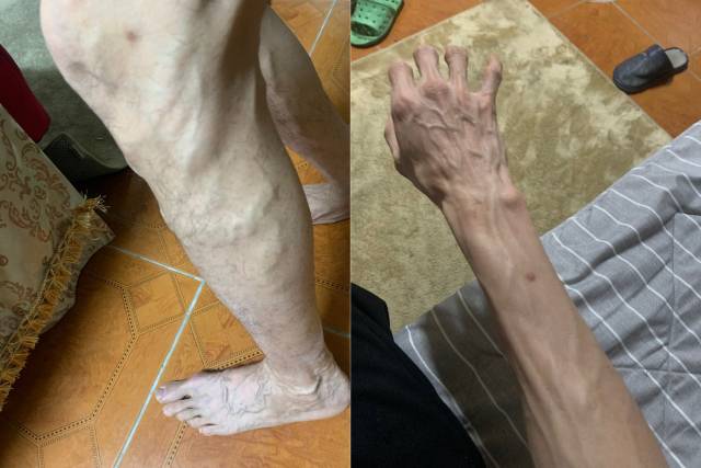 ▲민 씨의 팔과 다리. 레 비엣 민 제공.
