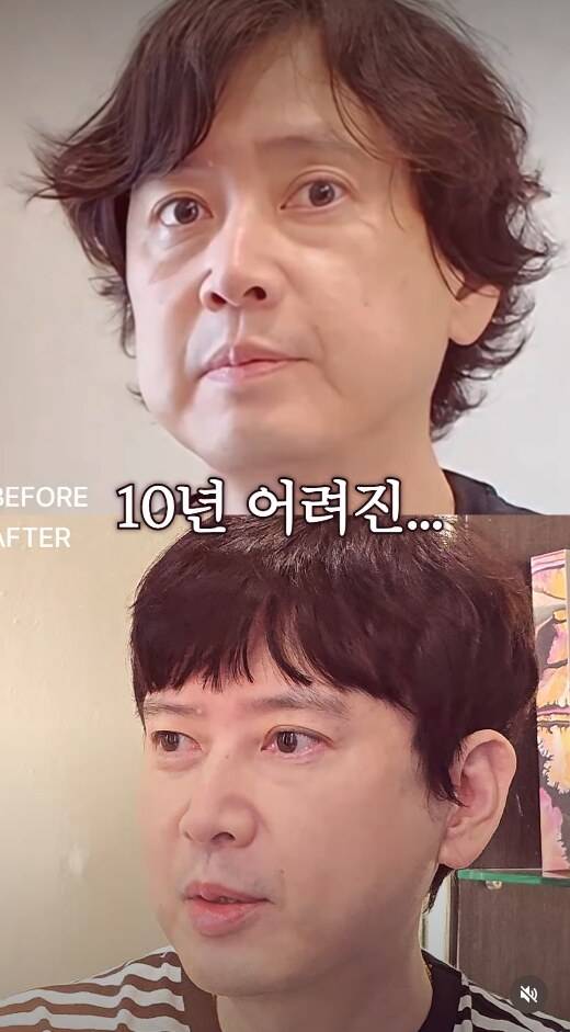 ▲ 배우 김진의 시술 전후 모습이 화제다. 출처ㅣ circleclinic_official 계정
