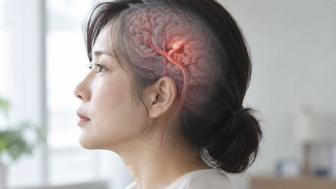 뇌동맥류는 증상이 없어서 뇌혈관 검사를 받지 않을 경우 발견하기 어렵다|출처: ChatGPT 생성