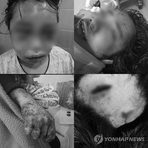 지난 9월 6일 피해자 부모가 SNS를 통해 공개한 피해 여중생 모습 [연합뉴스 자료사진]