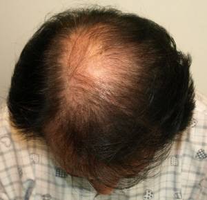 유전에 의한 탈모 사례 4. 이마 부위보다 정수리 부위의 탈모가 훨씬 심한 경우