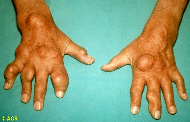 만성결절 통풍 환자의 손(사진=인천성모병원 제공)