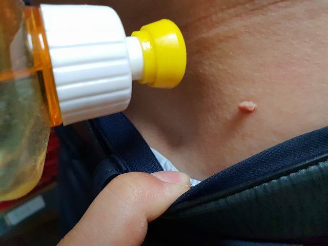 온라인에서 흔히 볼 수 있는 식초를 이용한 쥐젖 제거 방법은 피부에 손상을 줄 수 있는 위험한 방법이다. 대구 애플피부과 제공.