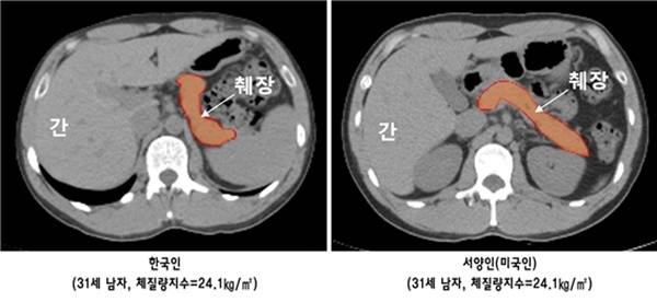 한국인과 서양인(미국인)의 췌장 크기 비교 . 같은 나이, 동일 체형에서 서양인에 비해 한국인이 췌장 크기가 작고 췌장내 지방 침착은 많다. 사진=분당서울대병원 제공