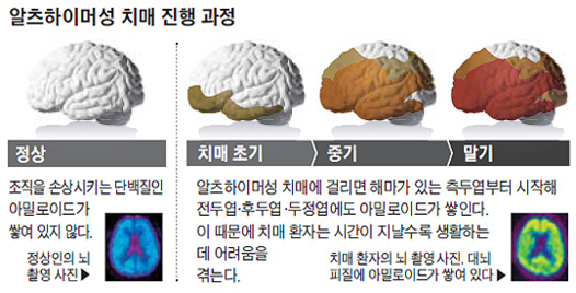 알츠하이머성 치매 진행 과정. /한국치매협회