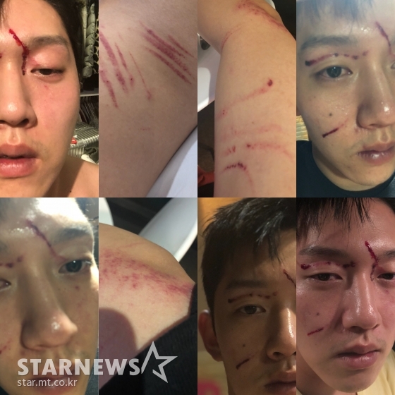 구하라 전 남자친구 최종범 측이 스타뉴스에 공개한 9월 13일 폭행 사건 당시 피해를 입었다고 주장한 상처의 모습 /사진=최종범 측