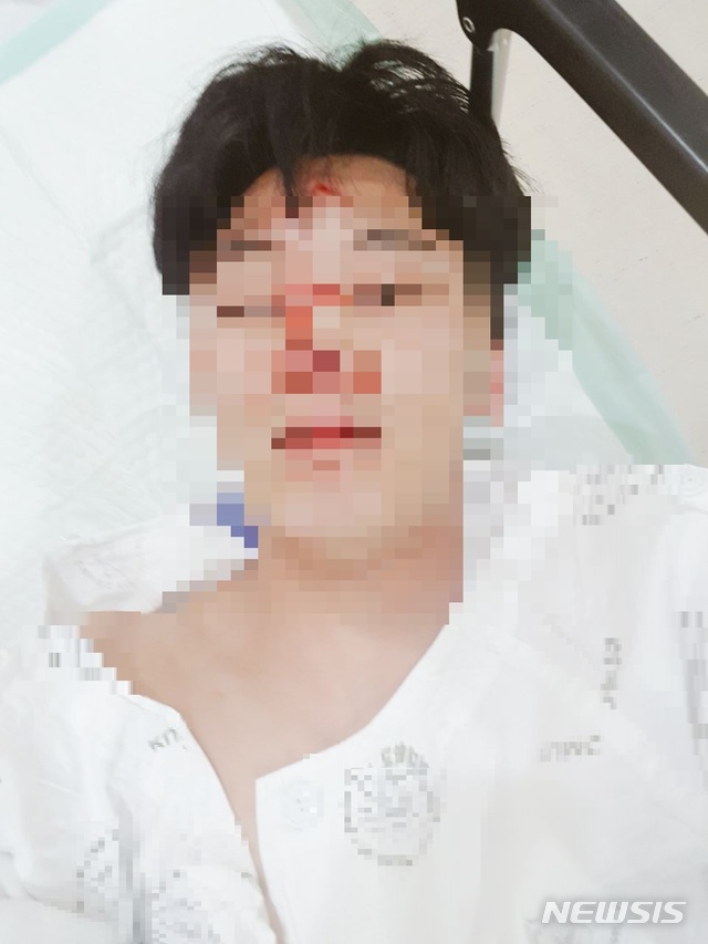 【서울=뉴시스】지난 10일 여성을 때리는 남성을 말리다 폭행을 당한 B씨의 모습. B씨는 코뼈가 부러져 수술을 받았다. 2018.11.15. (사진 = 피해자 제공)