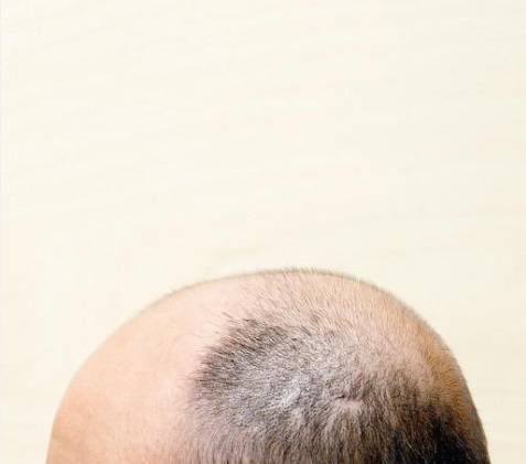 대머리를 유발하는 DHT라는 호르몬은 정수리와 앞이마 머리카락 성장은 억제하지만, 그 밖의 부위 털의 성장은 오히려 촉진하는 특징이 있다./사진=헬스조선 DB