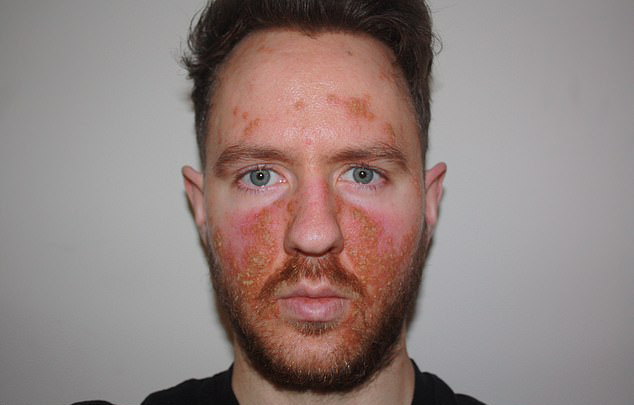 여드름 치료를 위해 사용한 스테로이드 크림 부작용으로 ‘좀비 피부’를 갖게 된 맷 헤스(27)