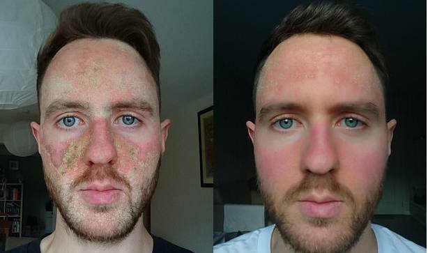 왼쪽은 스테로이드 크림 사용 당시 모습, 오른쪽은 스테로이드 크림 사용을 중단하고 식단을 조절한 뒤 개선된 피부 모습