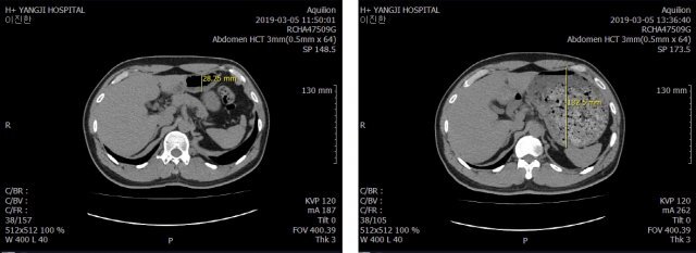 식사 전(왼쪽), 후 (오른쪽) CT 사진