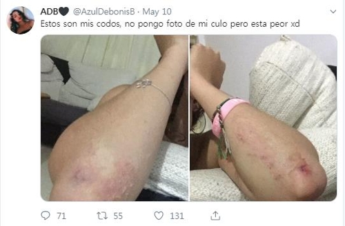 한 여성이 에스테포나에서 미끄럼틀 타다가 부상당한 팔꿈치를 공개했다. [트위터 캡처]