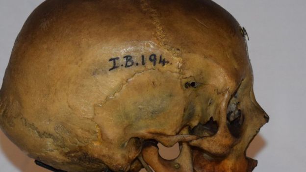 힐다의 실제 두개골은 에든버러대 해부학과 전시실에 보관돼 있다.(사진=에든버러대)