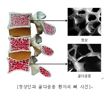 정상인과 골다공증 환자와 뼈 내부 사진 비교. [자료 서울아산병원]