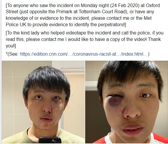 [런던=뉴시스] 영국 수도 런던 한복판에서 아시아계 학생이 신종 코로나바이러스 감염증(코로나19) 확산 사태에 따른 인종차별적 폭행을 당하는 일이 벌어져 경찰이 수사에 나섰다. 사진은 피해를 입은 싱가포르 유학생 조너선 목(23)이 사건 직후 자신의 페이스북에 올린 것. <출처: 페이스북> 2020.3.3.