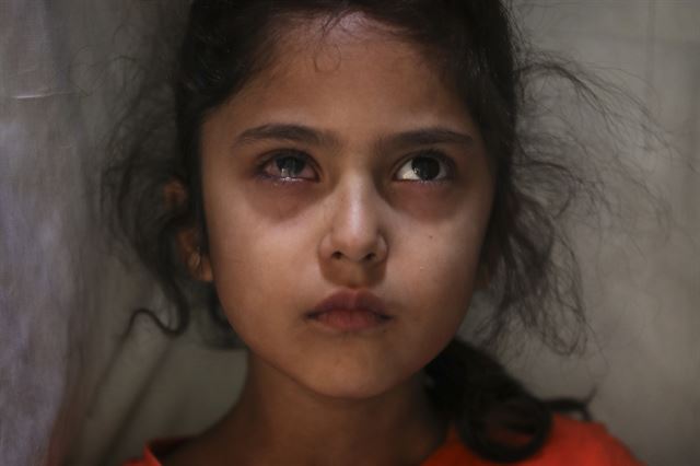 경찰이 쏜 고무총탄에 오른쪽을 맞은 카슈미르의 여섯 살 소녀. 2020 퓰리처상 피쳐 사진(Feature Photography) 부문 수상작 중 한 장면. AP 연합뉴스